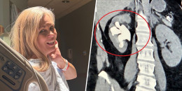 split image: Chrissi Anderson / x-ray of kidney stone